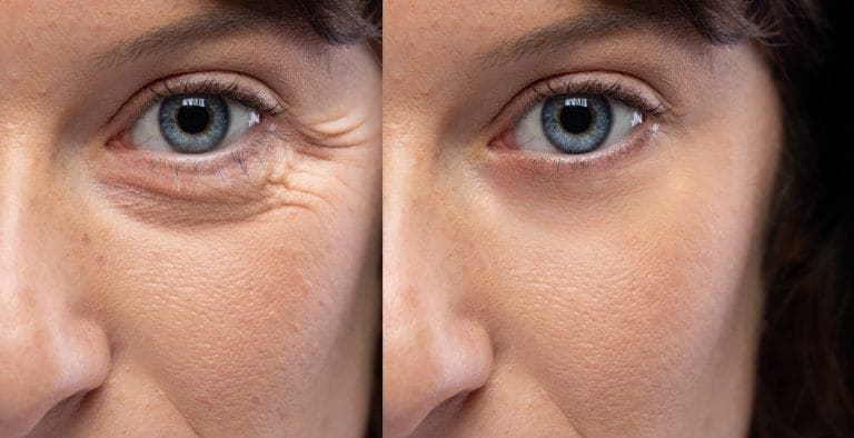 Botox treatment before and after results